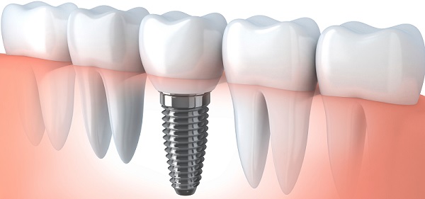 implantologia-dentale-risultati